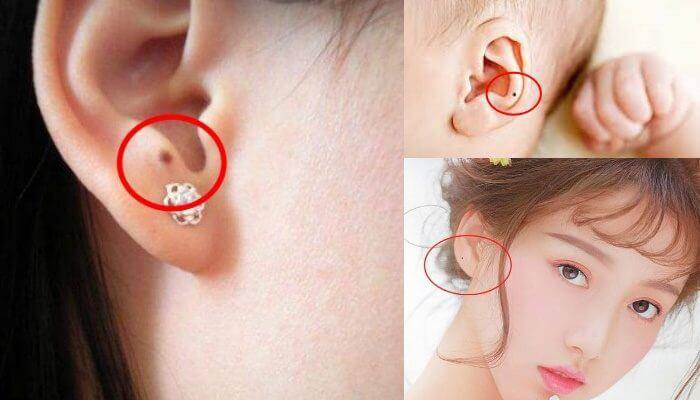 Nốt ruồi ở dái tai
