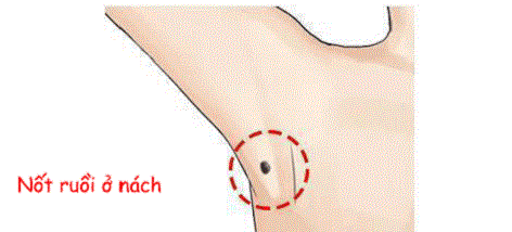 Nốt ruồi ở nách
