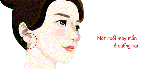 Nốt ruồi ở dái tai