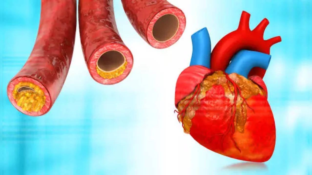 Mỡ máu cao là yếu tố hàng đầu gây đau tim, đột quỵ