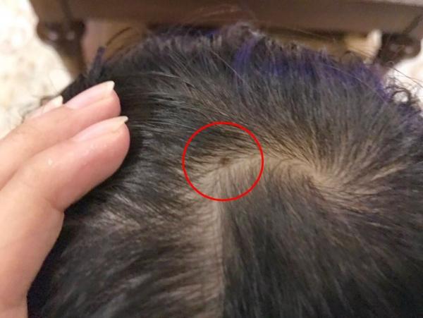 Nốt ruồi trên cổ