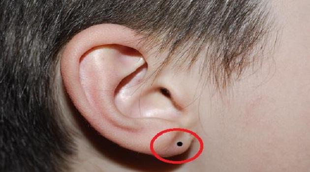 Nốt ruồi trên ngón tay
