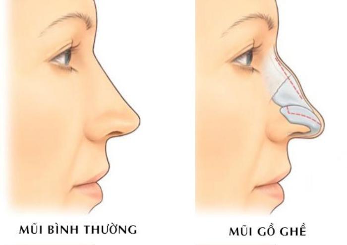 Đầu mũi tròn, cánh mũi đầy đặn