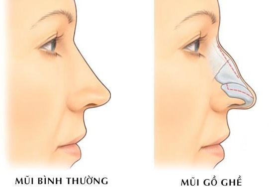 Mũi tẹt