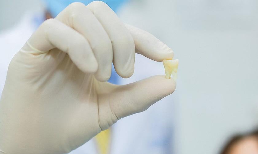 Giải mã giấc mơ tự nhổ răng