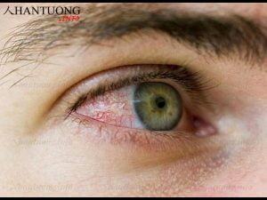 Xem tướng mắt có tia máu đỏ, nổi gân đỏ tốt hay xấu?