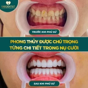 Làm răng phong thủy thêm vận may, nhận lộc phú quý