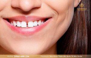Răng cửa thưa tướng số tốt không? Ảnh hưởng gì đến tài vận và hậu vận?