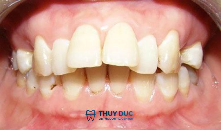 Xem tướng người răng hô chính xác nhất