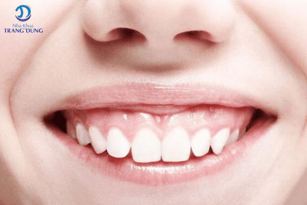Bọc răng sứ thẩm mỹ
