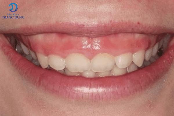 Răng ngắn trong nhân tướng học