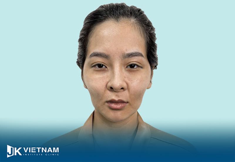 Thái dương lõm gò má cao là thế nào? Nguyên nhân, cách khắc phục