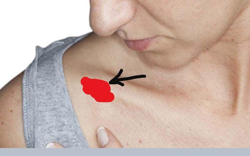 vết bớt đỏ ở xương quai xanh