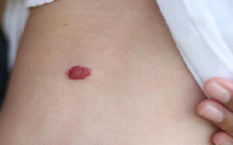 vết bớt đỏ ở rốn
