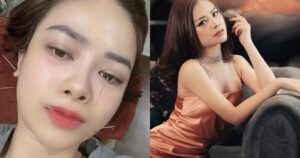 Dương Hoàng Yến môi méo, sưng mặt vì liệt dây thần kinh số 7: Ai dễ mắc bệnh này?