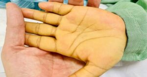 5 Dấu hiệu nhận biết sớm ung thư gan cần chú ý để cứu sống bản thân