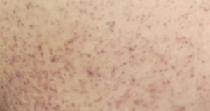 Cô gái 21 tuổi suýt mất mạng vì sốc sốt xuất huyết Dengue nặng