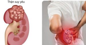 Cách nhận biết thận khỏe hay yếu để bảo vệ sức khỏe của bạn