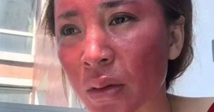 Không tẩy trang trong 22 năm , người phụ nữ đối mặt với biến dạng khuôn mặt nghiêm trọng