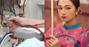 Suy thận trẻ hóa: Cảnh báo sức khỏe từ trường hợp ngân hòa