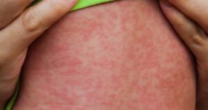 TP . HCM công bố hết dịch sởi 100 % Nhờ tiêm chủng hiệu quả cho trẻ em