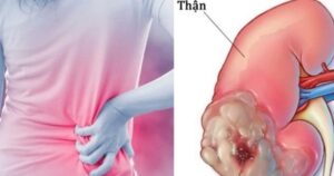Những dấu hiệu âm thầm của ung thư thận dễ bị bỏ qua