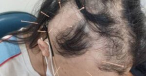 Rụng tóc từng mảng: Nguyên nhân và cách điều trị hiệu quả cho sức khỏe tóc