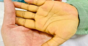 Sụt cân và mệt mỏi - dấu hiệu ung thư gan cần chú ý ngay