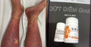 CẢNH BÁO KHẨN CẤP về thuốc Phenylbutazone: Nguy cơ chết người từ việc lạm dụng thuốc