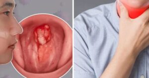 9 Dấu hiệu ung thư vòm họng giai đoạn đầu cần nhận biết sớm để điều trị hiệu quả