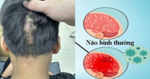 Câu chuyện cổ tích về cậu bé vượt qua viêm màng não đặc biệt đầy xúc động