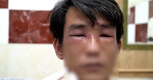 Kiến ba khoang tấn công người dân TP . HCM , Bác sĩ khuyến cáo cách chữa trị an toàn