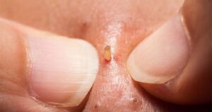 7 lý do nhiều người nghiện xem clip nặn mụn dù trông rất ghê