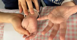 Tưởng con sốt phát ban, bà mẹ tá hỏa khi bác sĩ kết luận tay chân miệng