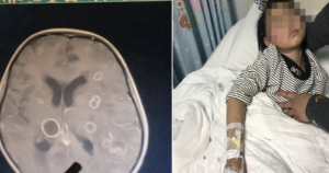 Bé gái lớp 2 bị nhiễm nấm Aspergillus: Cảnh báo sức khỏe cho trẻ nhỏ