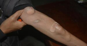 Cánh tay người chạy thận và những Điều ít ai biết về sức khỏe thận