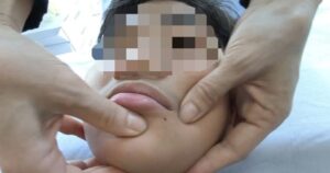 Liệt dây thần kinh số 7 do rét đậm