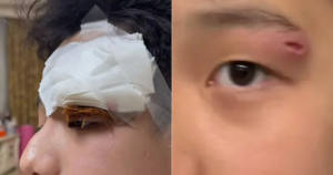Nữ diễn viên nổi tiếng Cảnh báo nguy hiểm Khi nặn mụn cho con trai