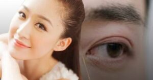 Sau 40 tuổi , khóe mắt có thể cảnh báo nguy cơ mất trí nhớ cao hơn 60 %