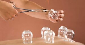 Giác hơi và đánh cảm: Lợi ích và rủi ro cần biết năm 2026