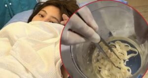 Một phụ nữ 32 tuổi thải ra sán dây bò dài 3 mét , nguyên nhân từ thớt dùng sai