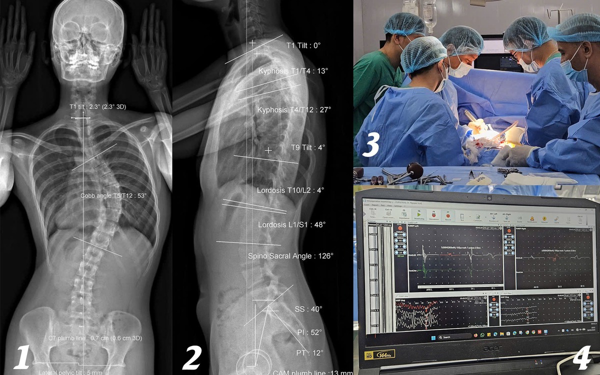 Cô gái 18 tuổi phát hiện vẹo cột sống 53 độ , phẫu thuật thành công