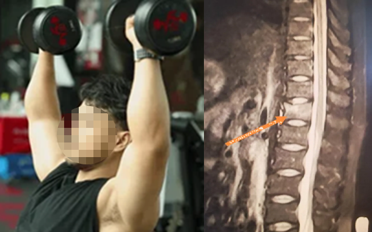Người đàn ông 34 tuổi gãy xương như bà cụ 60 tuổi vì uống 3 cốc nước hàng ngày