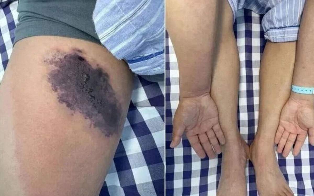 Người đàn ông suýt nhiễm độc toàn thân Vì cắn nhện trong chiếc quần cũ