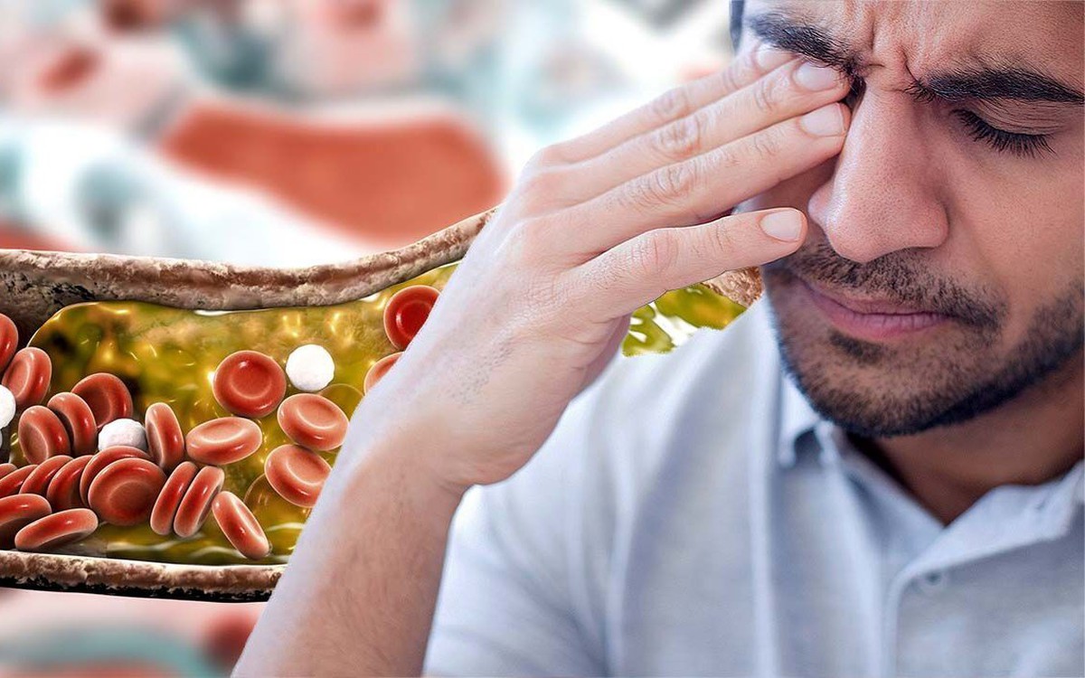 Nhận biết mỡ máu cao qua khuôn mặt: 2 Dấu hiệu cảnh báo bạn không nên bỏ qua