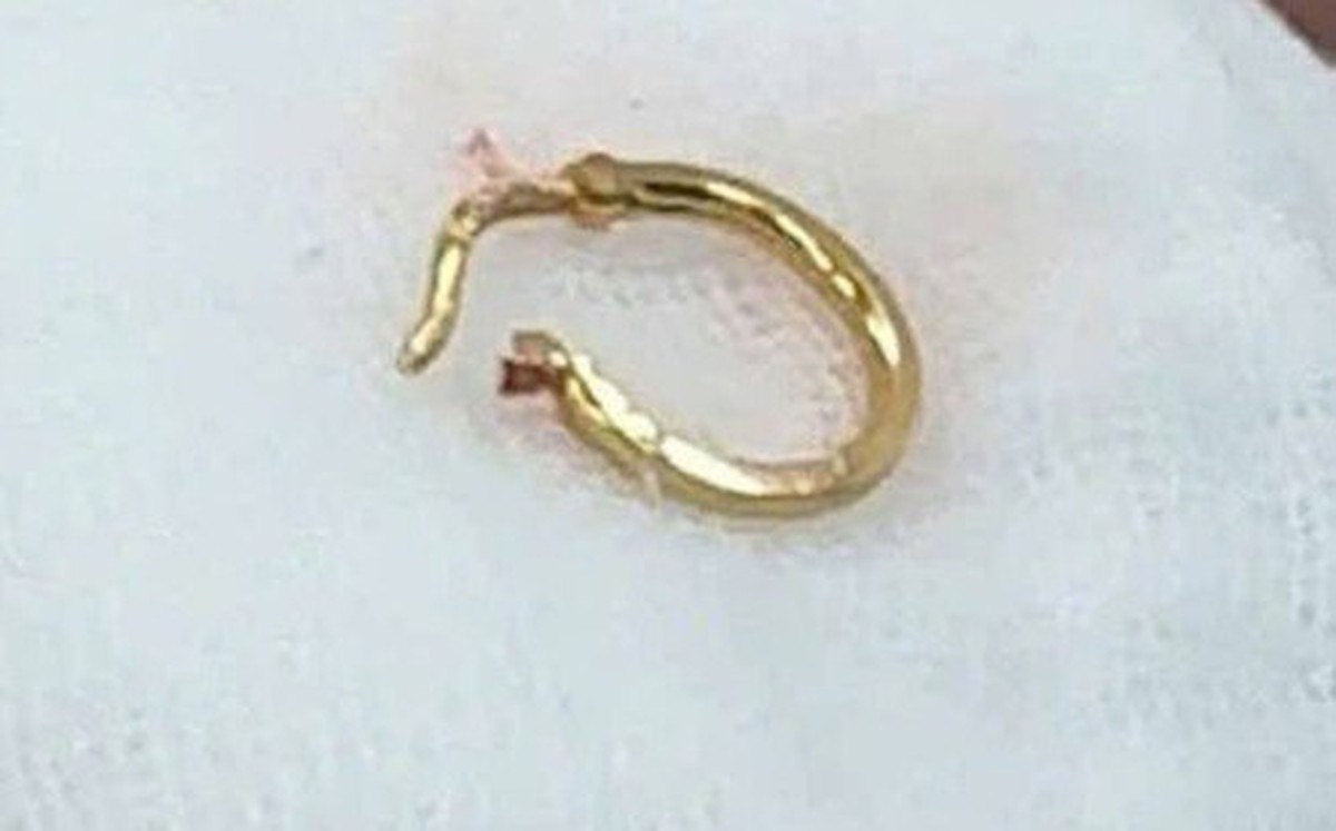 Bé gái 8 tháng tuổi nhập viện vì bông tai trong thực quản cần lưu ý cho mẹ