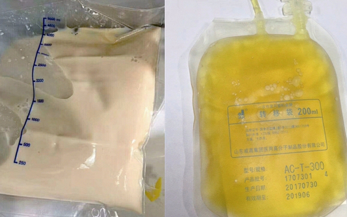 Cô gái 27 tuổi máu đục như trà sữa và "nhiều dầu" vì kiểu ăn tiện lợi của nhiều người Việt trẻ