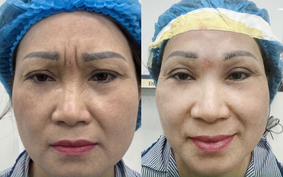 Giải pháp cắt triệt cơ cau mày từ Ths . Bs Phạm Tiến Mạnh nâng Cao sức khỏe tinh thần
