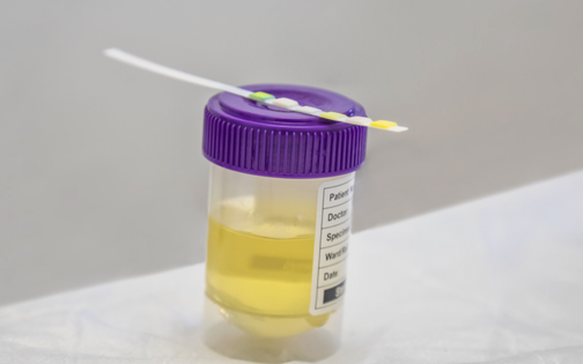 Vì sao test nhanh ma túy vẫn âm tính? Nguyên nhân và giải pháp cần biết