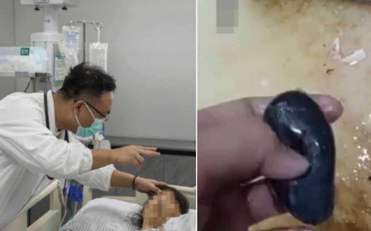 Người phụ nữ suy gan cấp vì mẹo dân gian chữa đau đầu , bác sĩ cảnh báo nguy hiểm